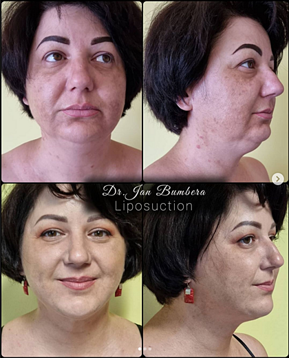 Chin correction using liposuction
