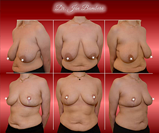 Reduction mammaplasty
